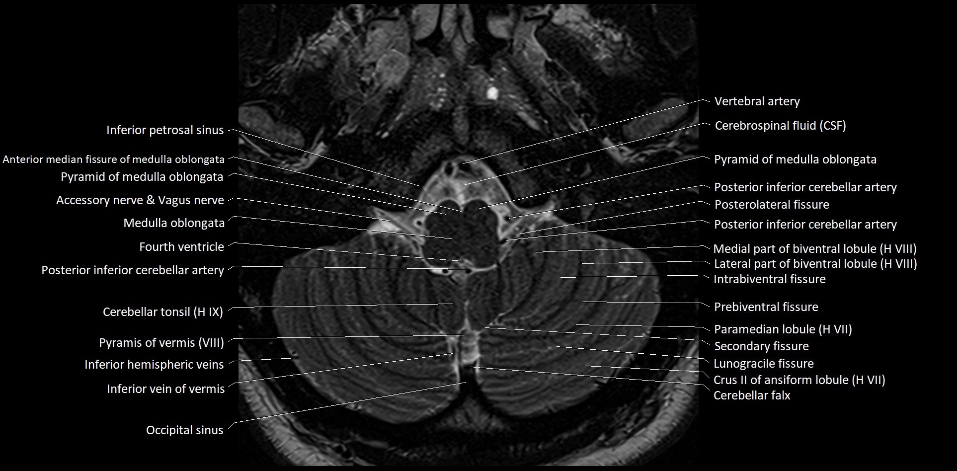MRI Cerebellar anatomy High-resolution labelled 3T MRI image 7.webp